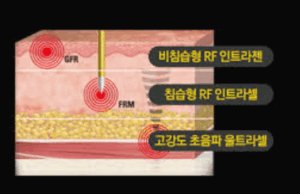 울트라셀 시술주기